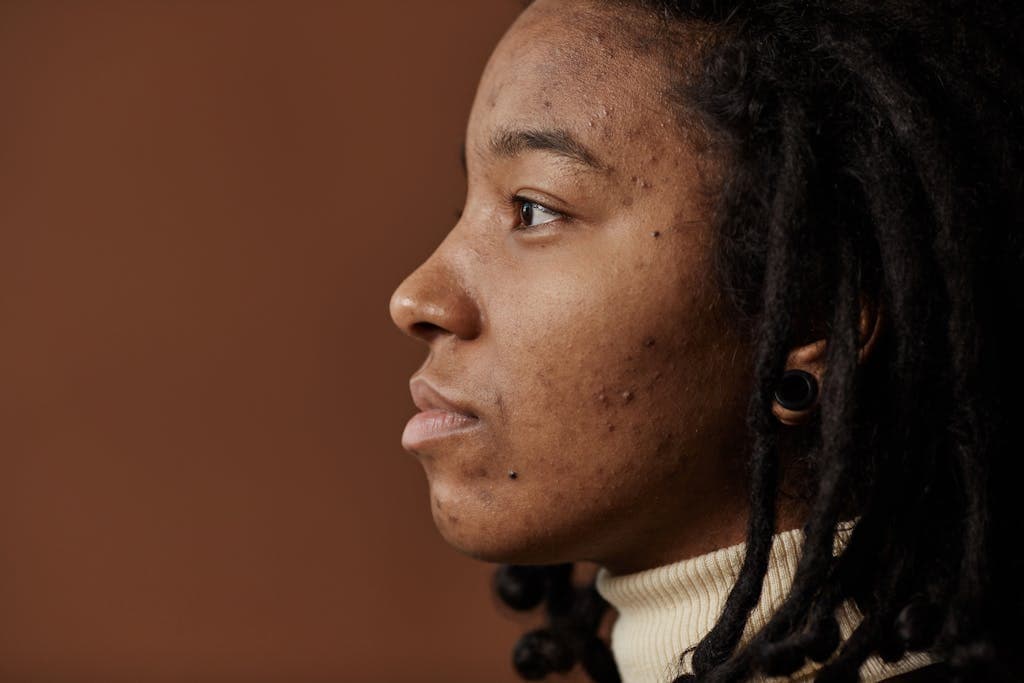 Profile portrait of a young woman with natural hair and visible skin texture. - Why You Should Care About Non-Comedogenic Products For The Skin